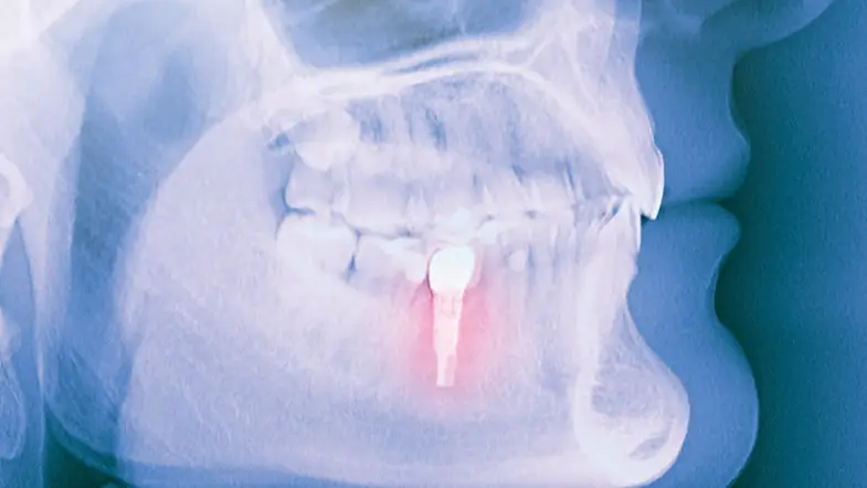 Peri-İmplantitis Nedir? peri implantitis nedir tedavisi ankara