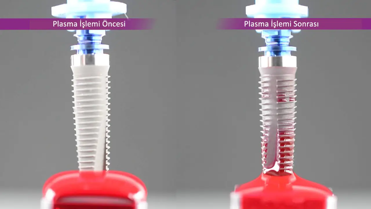 Ankara Plasma Active İmplant Uygulaması Plasma Active İmplant Fiyatları