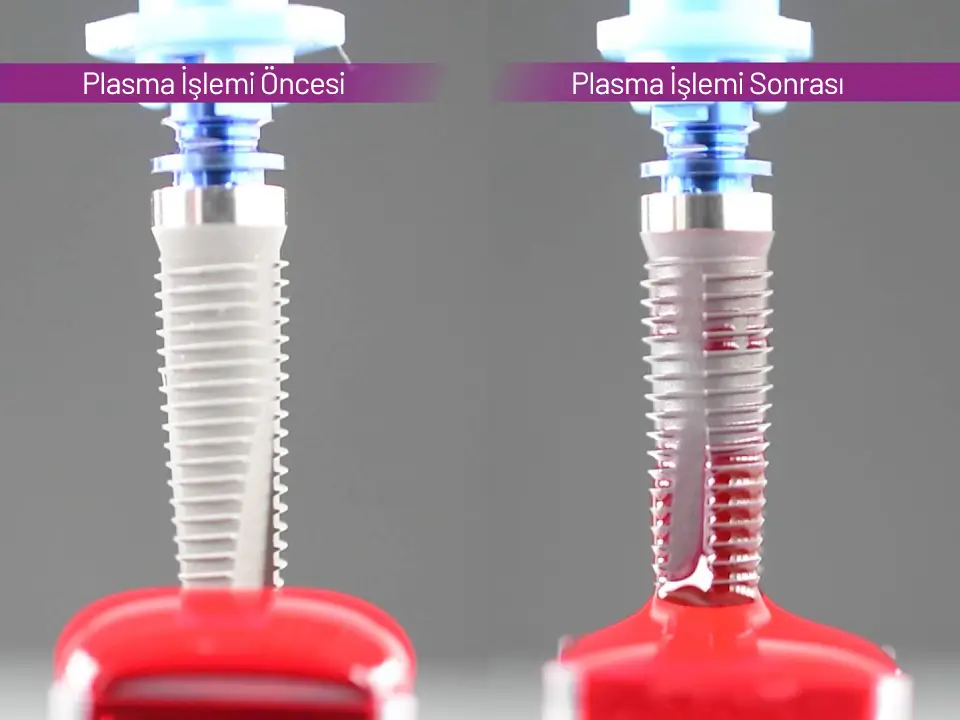 Plasma Active İmplant Fiyatları Ankara. Plazma İmplant Nedir?