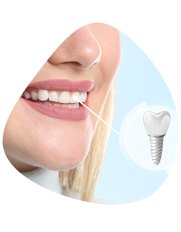 implant ankara